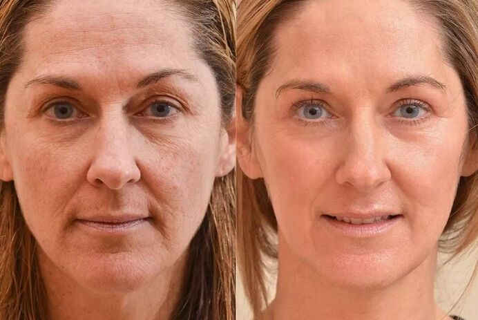 Face rejuvenation before and after