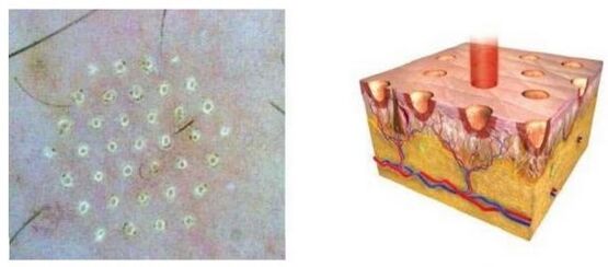 The fractional laser affects the skin point