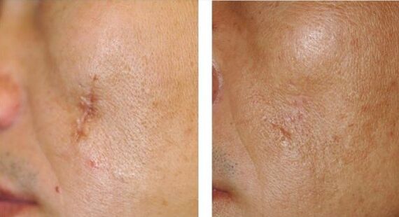 The result of the laser