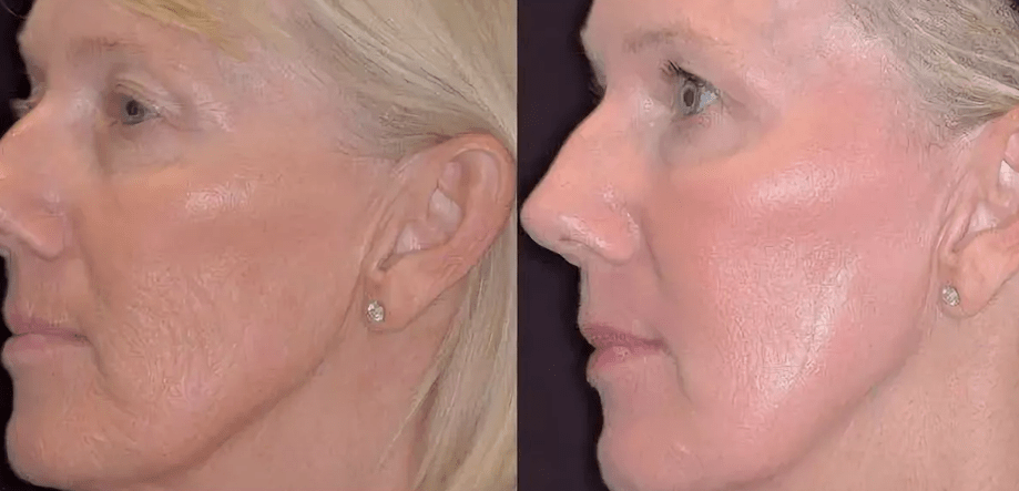 Phototherly Laser before and after