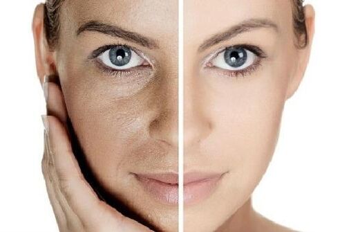 Ringing the skin with your blood plasma