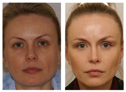 Course of injections with meso cocktail
